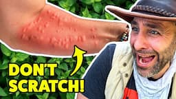 STUNG by a Costa Rican Bush!