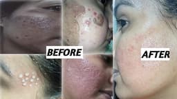 2015-2020 Remove Acne Scars || क्या आपके चेहरे पे एक्ने के बाद के गड्ढे है? तो ये विडियो आपके लिए है