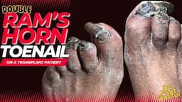 Ram’s Horn Toenail on a Transplant Patient