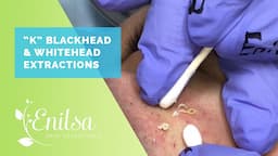 Blackheads, Whiteheads Extractions on "K" - Part 2