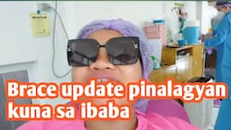 Update brace nka brace na lahat ng ngipin ko