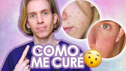 YO SUFRI DE ACNE : Mi experiencia y como me curé - Recomendaciones, consejos y mas