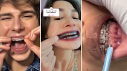 Orthodontist Reacts To Painful Dental TikToks