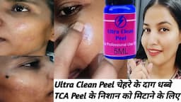 Ultra Clean Peel || Acne Scars,चेहरे के दाग धब्बे, TCA के निशान || Application, Before After Result