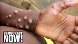 “Immense Frustration”: Monkeypox Spreads Amid Slow U.S. Response; WHO Declares Emergency