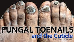 Fungal Toenails and the Cuticle