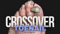 Crossover Toenail: Trimming Thick Fungal Toenails