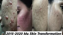 My Skin Transformation Part-2 || 2015-2020 Remove My Acne Scars Journey || एक्ने स्कार्स