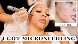 MY FIRST PROFESSIONAL MICRONEEDLING EXPERIENCE!! | ACNE SCARS, DARK MARKS, TEXTURE PT.1