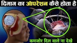 दिमाग का ऑपरेशन कैसे होता है | How Does Brain Surgery Work