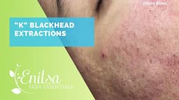 Blackhead Extractions Special "K" Another Great Video