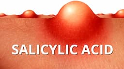 Here's WHY Salicylic Acid is Best For ACNE