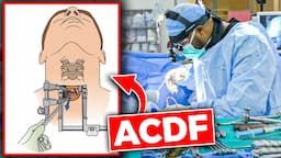 Anterior Cervical Discectomy and Fusion (ACDF)