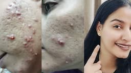 डर्मापेन चेहरे के गड्ढों के लिए || Darmapen for acne scars|| एक बार फिर से पूरी जानकारी के साथ