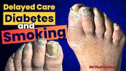 Delayed Care, Diabetes, and Smoking: Treating Thick, Fungal Toenails