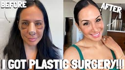 MY PLASTIC SURGERY JOURNEY!!! | JO DE LA ROSA