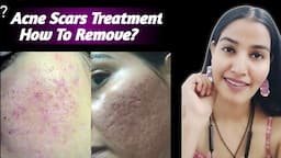 Best Skincare Treatment For Acne Scars || Remove Acne Scars #howtoremoveacnescars