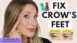 Treatments for Crow's Feet That WORK | Fix Eye Wrinkles | Dr. Sam Ellis