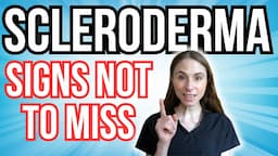 Signs Of Scleroderma NOT TO MISS