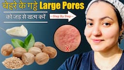 In 7 Days💕 चेहरे के पुराने गड्ढे, DEEP ACNE SCARS, LARGE PORES को जड़ से ठीक करें इस Remedy से