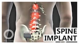 Revolutionary Spine Implants Let Paraplegics Walk Again