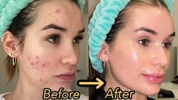 How I Finally Cleared My Acne and Textured Skin! *Hormonal Acne Skincare Routine*