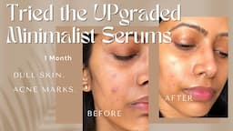 I tried these Minimalist Skincare Upgraded NEW Serums for a month on my dry, sensitive, acne skin