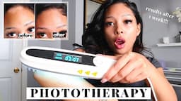 *HONEST REVIEW* Trying light therapy on psoriasis for 2 months...This is what happened!!