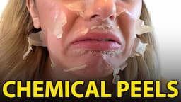 Will Chemical Peels DESTROY Your Face?