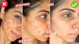 Skincare *MISTAKES* Making Your ACNE WORSE! Easy Skincare Tips For Acne | Ishita Khanna