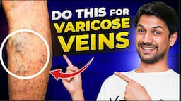 VARICOSE VEINS explained under 10 minutes | Saurabh Bothra Yoga