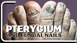 Pterygium and Fungal Toenails