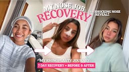 RHINOPLASTY RECOVERY & NOSE REVEAL!!! [ Before & After + Guidelines & Tips ]