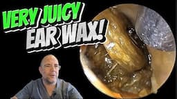 VERY JUICY EAR WAX! 290 #ear #earwax #earwaxremoval #earcleaning #fyp #asmr #foryou #satisfying