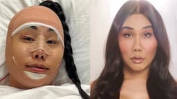 My Facial Feminization Surgery Story | Gia Gunn