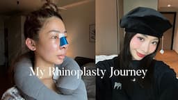 MY RHINOPLASTY JOURNEY 👃🏼✨