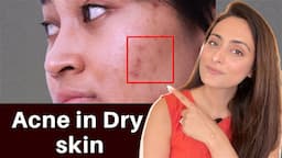 Acne in Dry Skin | what to use | serums, creams | Dermatologist recommends