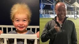 Uncombable Hair Syndrome and Other Rare Genetic Conditions