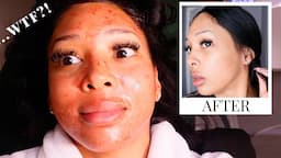 TRYING THE VAMPIRE FACIAL!!! 😳 MICRONEEDLING WITH PRP BEFORE + AFTER PT.2