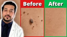 How to Rid Skin Tags FASTER | 3 Easy Skin Tag Removal Steps