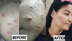 Acne & Acne Scars Permanently Remove || सिर्फ एक क्रीम से एक्ने और उसके स्कार्स खत्म हो सकते है