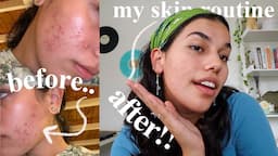 How I Cleared My Acne, skincare routine & tips!!