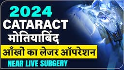 AI Laser Cataract Surgery with Alcon's Vivity Lens - मोतियाबिंद का इलाज लेज़र सर्जरी से