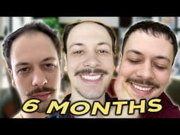 my first 6 MONTH with a FUT Hair Transplant (2023 US Surgury)