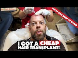 Had a Cheap Hair Transplant in Turkey – This Happened! | SURGERY & FIRST 6 WEEKS