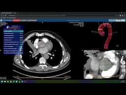 Trauma to Lung & Thyroid Nodules   2023 RSNA Imaging AI in Practice Demo