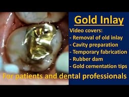 Gold Inlay On Upper Second Molar (Full Procedure And Commentary) | Indirect Case #2