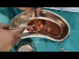 Huge Sebaceous Cyst Ruptures During Surgery