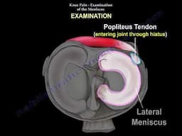 Meniscus tear   and knee pain