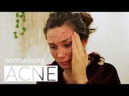 Normalising Acne - Documentary | Cerys Davies